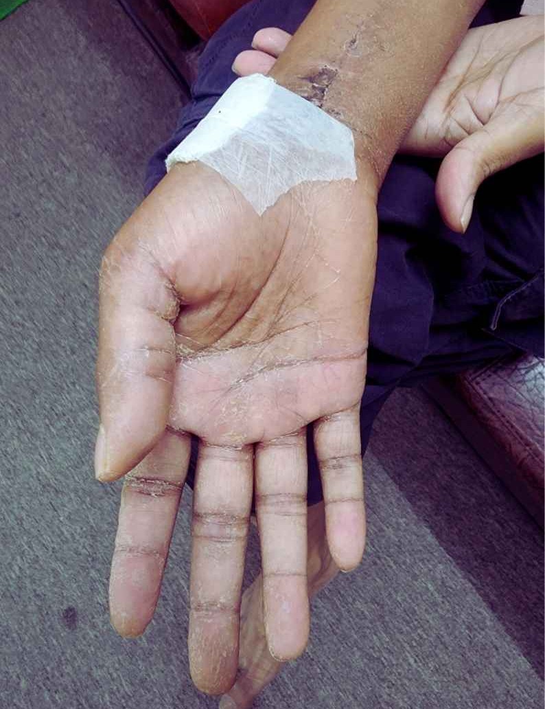 কলিস ফ্র্যাকচার সঙ্গে ইন্টারনাল ফিক্সেটর