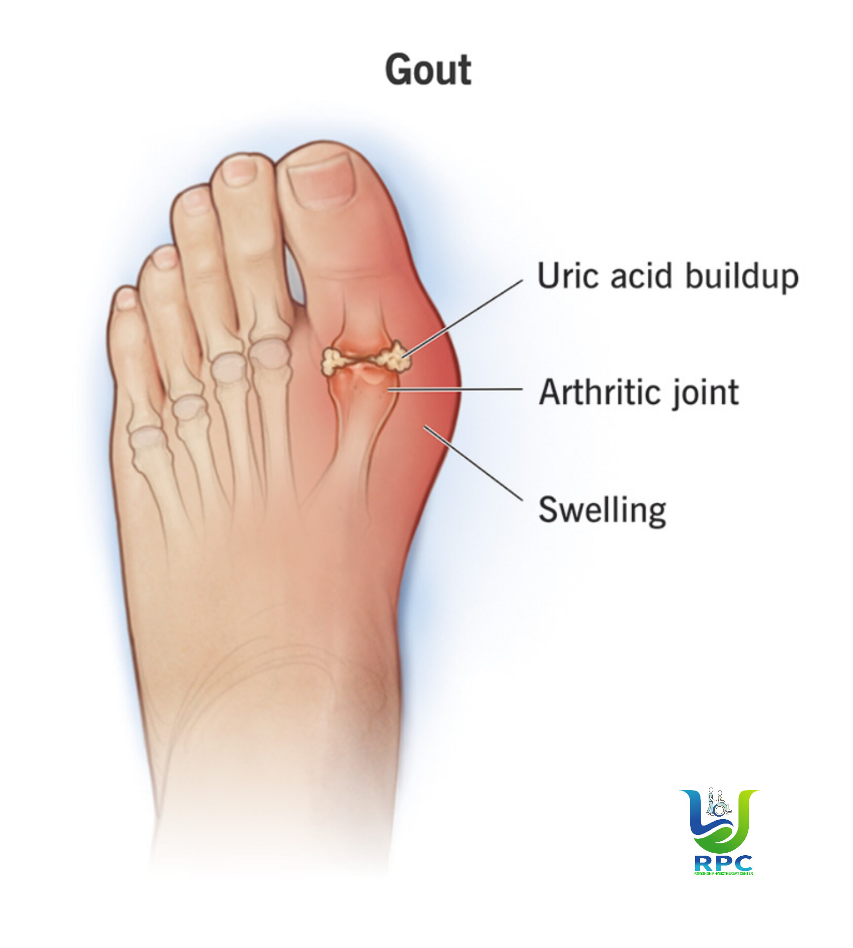 গাউট আর্থ্রাইটিস: কারণ, লক্ষণ ও ফিজিওথেরাপির ভূমিকা