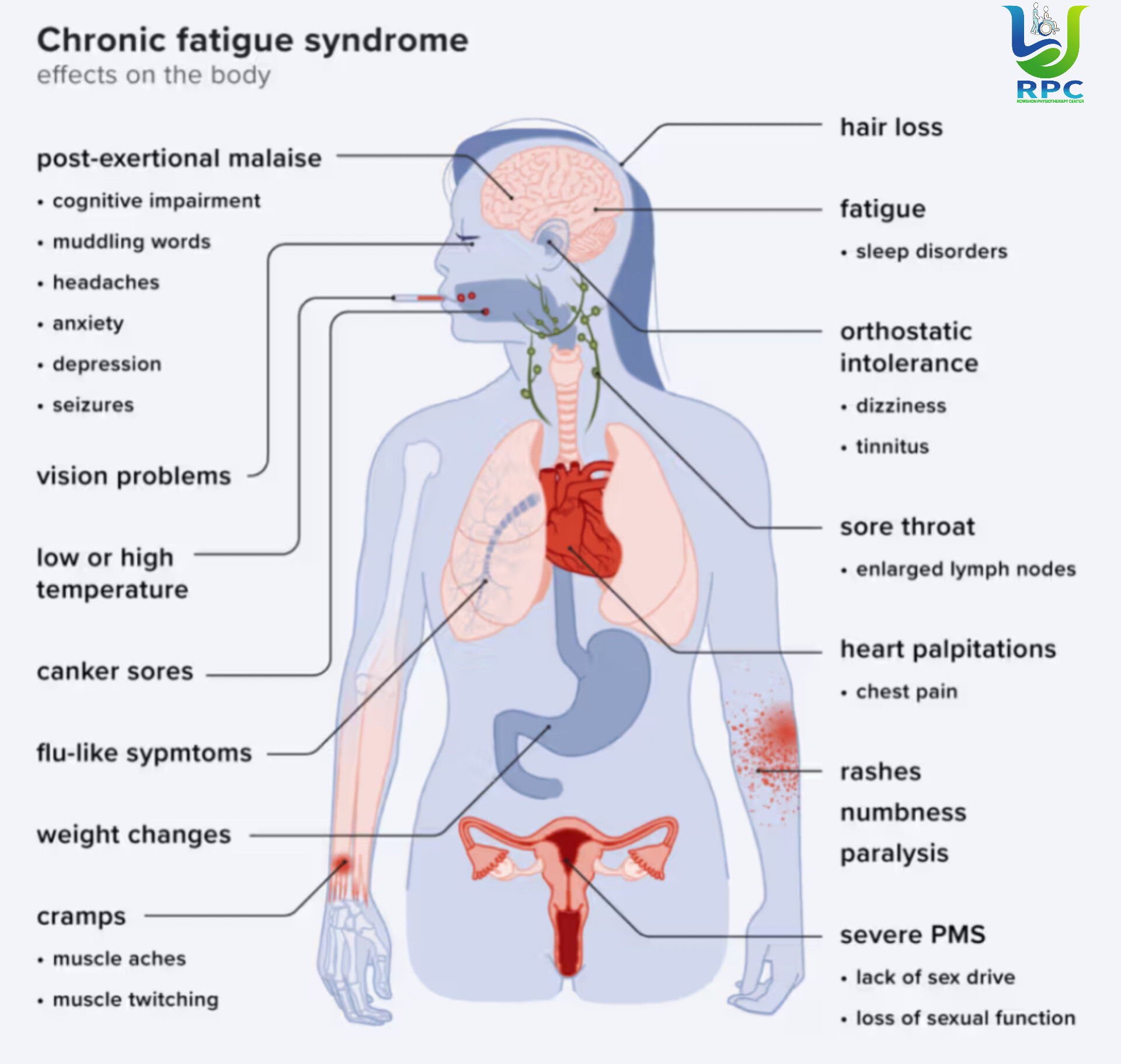 Chronic Fatigue Syndrome