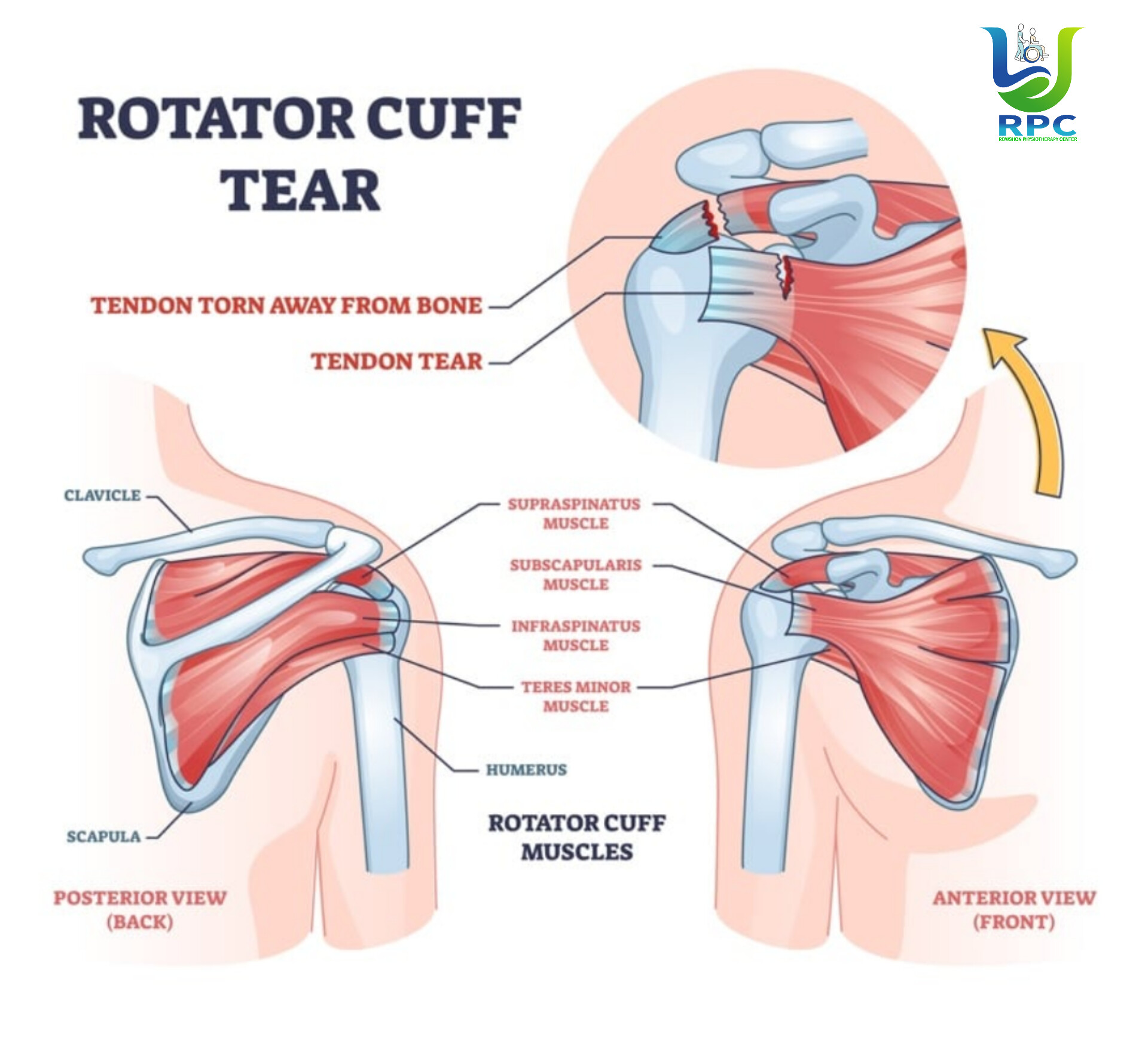Rotator Cuff Tear 