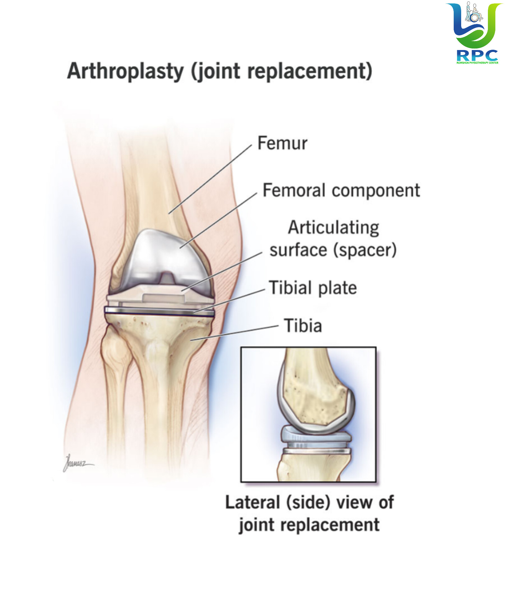 Joint Replacement 