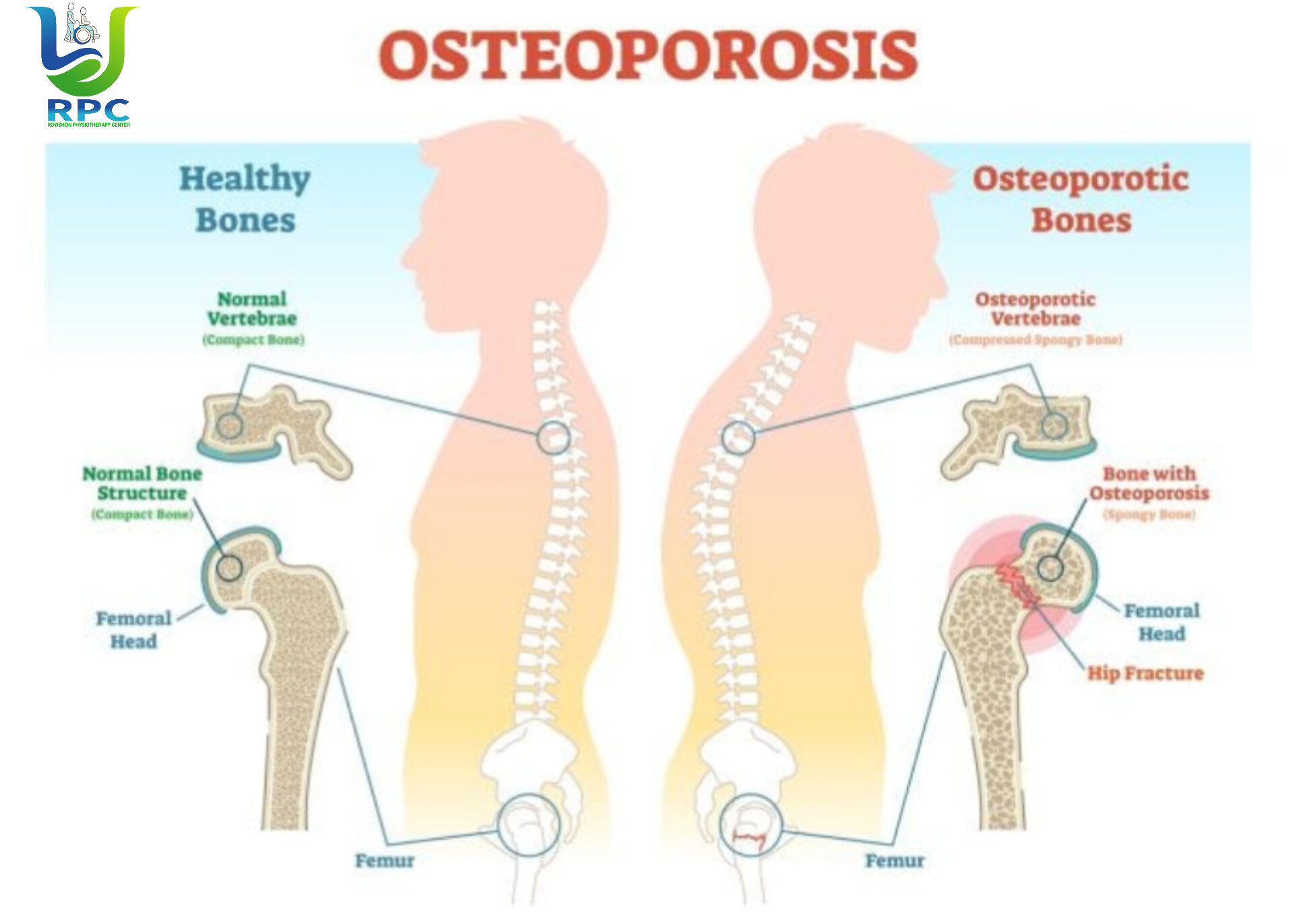 অস্টিওপরোসিস: নীরব হাড়ক্ষয়ের রোগ—কারণ, উপসর্গ, প্রতিরোধ ও ফিজিওথেরাপি ব্যবস্থাপনা