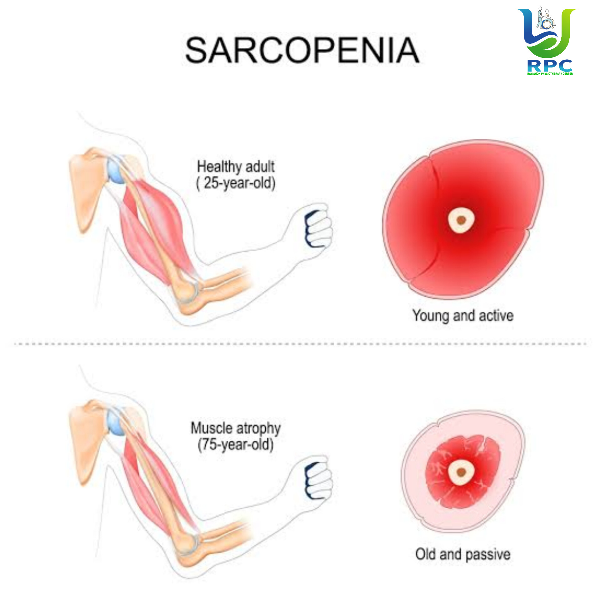 সারকোপেনিয়া: নীরব পেশিক্ষয়ের রোগ—কারণ, উপসর্গ, প্রতিরোধ ও ফিজিওথেরাপি ব্যবস্থাপনা
